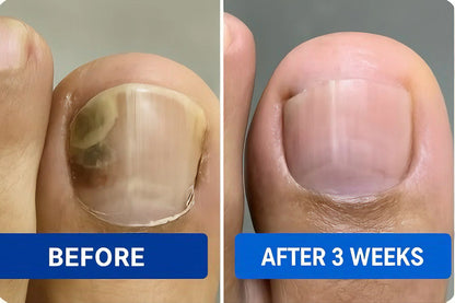 Nuvex Fungal Nail Renewal Patches