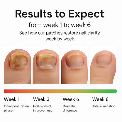Nuvex Fungal Nail Renewal Patches